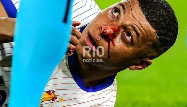 mbappe-narizjpg